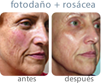 Luz pulsada para online rosácea antes y después